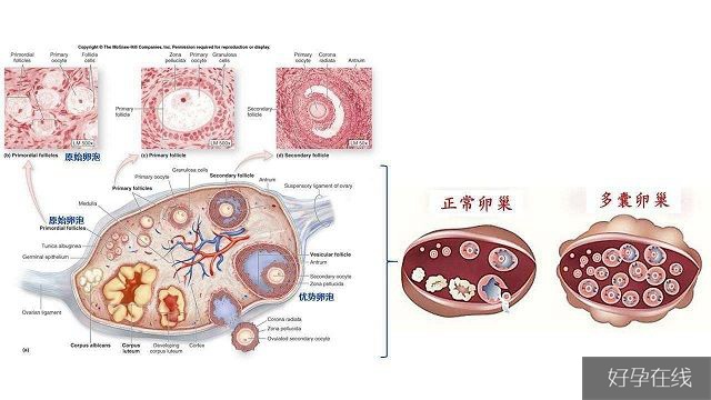 轻度的多囊卵巢综合症是可以治疗的