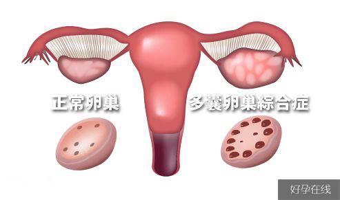 多囊卵巢的症状