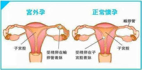 宫外孕与正常怀孕的对比图