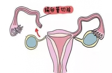 宁夏慈铭博鳌国际医院三代试管婴儿，切除双侧输卵管还能做试管婴儿吗？